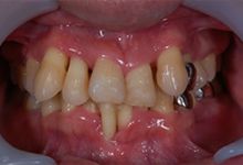 40歳男性の重度歯周病症例、術前