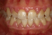25歳女性の歯周病症例、術前