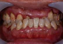 40歳男性の重度歯周病症例、術前