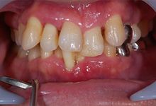 40歳男性の重度歯周病症例、術後