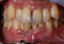 45歳男性の重度歯周病症例、術後