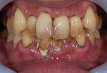 45歳男性の重度歯周病症例、術前