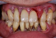 46歳男性の重度歯周病症例、術前