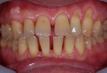 54歳男性の重度歯周病症例、術後