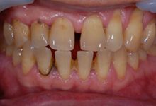 54歳男性の重度歯周病症例、術前