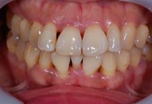 43歳女性の歯周病症例、術後