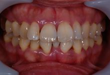 43歳女性の歯周病症例、術前