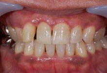 48歳女性の歯周病症例、術後
