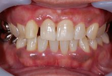 48歳女性の歯周病症例、術前