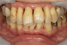 55歳女性の重度歯周病症例、術後