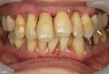 55歳女性の重度歯周病症例、術前