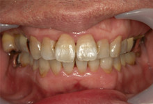 44歳男性の重度歯周病症例、術後