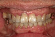 44歳男性の重度歯周病症例、術前