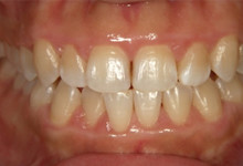 25歳女性の歯周病症例、術後