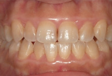 25歳女性の歯周病症例、メンテナンス経過状態