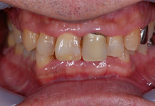 43歳男性の重度歯周病症例、術後