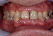 43歳男性の重度歯周病症例、術前