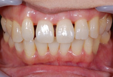 40歳女性の歯周病症例、術後