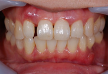 40歳女性の歯周病症例、術前