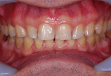 50歳男性の歯周病症例、術後