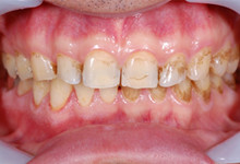 50歳男性の歯周病症例、術前