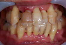 41歳男性の重度歯周病症例、術後
