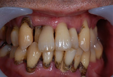 41歳男性の重度歯周病症例、術前