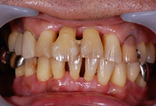 58歳男性の重度歯周病症例、術後