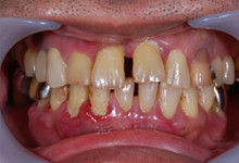 58歳男性の重度歯周病症例、術前
