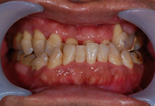 40歳男性の重度歯周病症例、術後