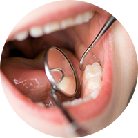 歯周病は抜歯の最大の原因
