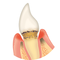 歯を支える骨（歯槽骨）の吸収