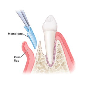メンブレンを設置し、歯周組織を再生させるGTR法