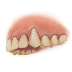 歯周病によって失われた骨を再生させるGEM 21S