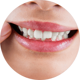 歯周病に失われた歯周組織の審美性の回復